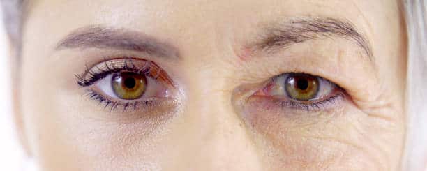 How is Floppy Eyelid Syndrome Associated With Sleep Apnea?