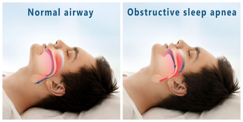 An Introduction Guide to Obstructive Sleep Apnea (OSA)
