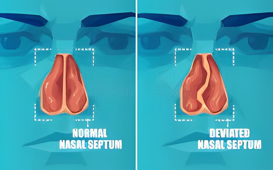 Identifying a Deviated Septum: A Guide to Self-Examination
