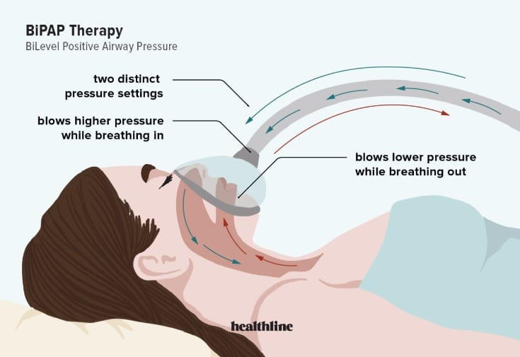 BiPAP Therapy: How It Works