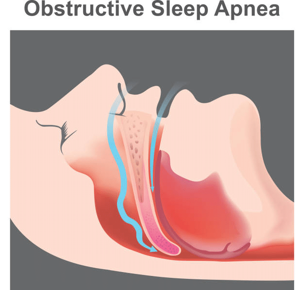The Mechanics of Sleep Apnea
